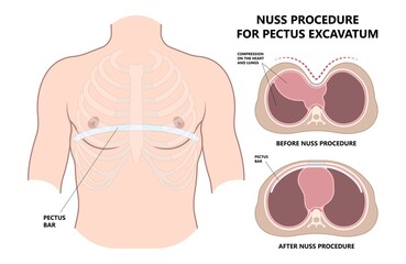 Chest wall disorder and Pectus ribs sunken funnel heart murmur lung COPD pain gene birth the barrel Marfan Ehlers Danlos Noonan Turner head thorax muscle brace sport injury Pleural effusion asthma