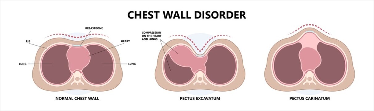 Chest wall disorder and Pectus ribs sunken funnel heart murmur lung COPD pain gene birth the barrel Marfan Ehlers Danlos Noonan Turner head thorax muscle brace sport injury Pleural effusion asthma