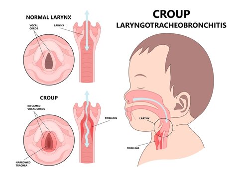 Croup upper airway obstruct virus voice box vocal cord tube swollen noise baby child cold flu sick stuffy runny nose fever common kids lung covid 19 RSV tract high pitched