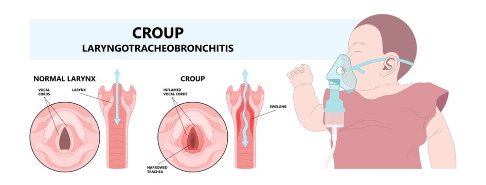 Croup Upper Airway Obstruct Virus Voice Box Vocal Cord Tube Swollen Noise Baby Child Cold Flu Sick Stuffy Runny Nose Fever Common Kids Lung Covid 19 RSV Tract High Pitched