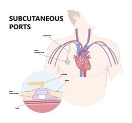 PICC Line insert neck tube vein arm blood draws heart IV needle cancer therapy Total peripheral internal double lumen chest port fluid injection large artery superior vena cava care drug implantation