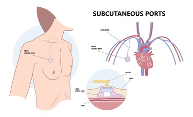 PICC Line insert neck tube vein arm blood draws heart IV needle cancer therapy Total peripheral internal double lumen chest port fluid injection large artery superior vena cava care drug implantation