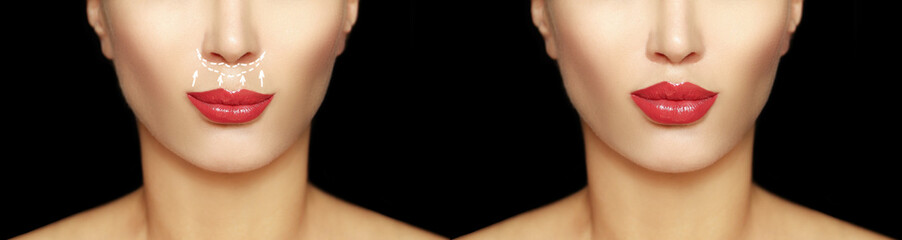 Fototapeta premium lip lift surgery,bullhorn technique, plastic surgery concept.