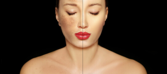 Dark spots, freckles,hyperpigmentation(melasma or chloasma),concept - skin lightening, skin...