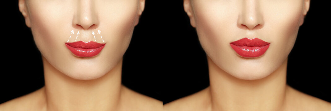lip lift surgery,bullhorn technique, plastic surgery concept.