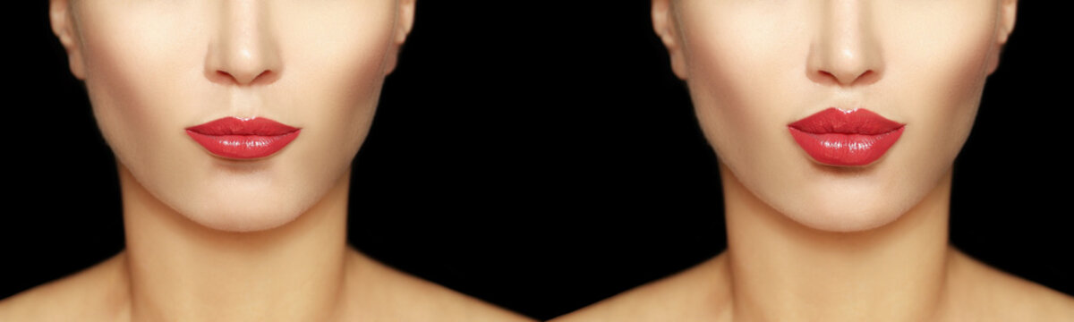 Beauty injections.Concept of rejuvenation.Lip augmentation