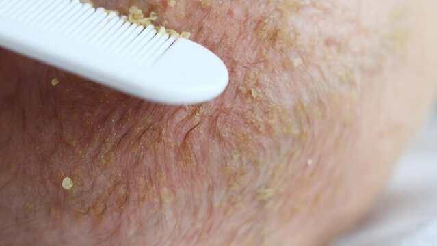 removing seborrheic dandruff flakes crusts off newborn baby child head with white comb. close-up view of infant's kid seborrhea dermatitis in hair. medical skin problem, combing and exfoliation