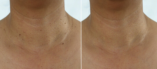 Skin texture retouched, skin tags removal before and after treatment concept - obrazy, fototapety, plakaty