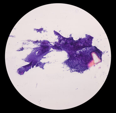 Scar endometriosis(FNA), microscopic image show benign epithelial cells and stromal cells, background show polymorphs, lymphocytes, histiocytes, blood, It is rare disease.