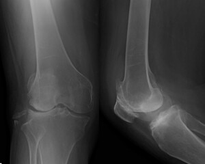 Osteoarthritis knee. show narrow joint space, osteophyte ( spur ), subchondral sclerosis due to...