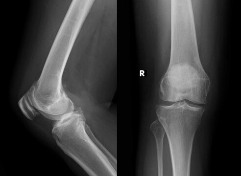 Osteoarthritis knee. show narrow joint space, osteophyte ( spur ), subchondral sclerosis due to degenerative change