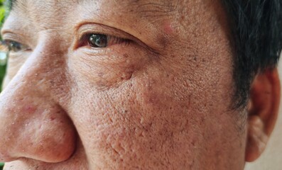 close up of a person showing the blemishes and dark spots on the face, problem wrinkles and rough skin on the face of the man, concept health care.