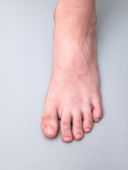 Foot of a young boy with weak or brittle nails, onychoschizia disease, isolated on gray background