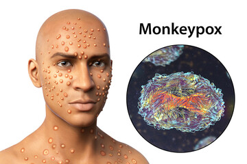 Patient with monkeypox and close-up view of monkeypox virus, 3D illustration