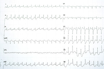 A positive stress induced myocardial ischemia with significant horizontal ST depression changes in...