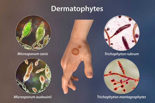 Hand fungal infection, tinea manuum, 3D illustration