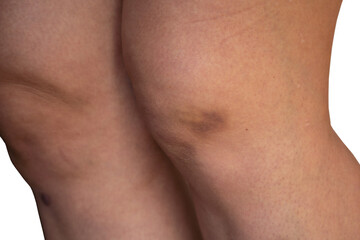 Femenine knee with a bruise and strawberry skin