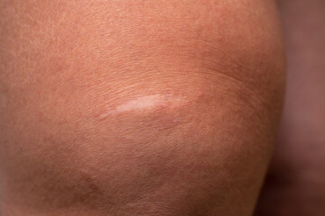 Mature white scar on the female knee