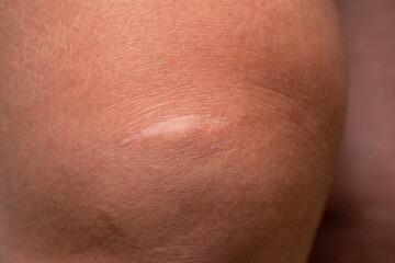 Fototapeta premium Mature white scar on the female knee