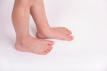 Syndactyly. Fused toes of a child, on a light background