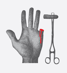 human hand with cut off finger on medical tweezers with blood - obrazy, fototapety, plakaty