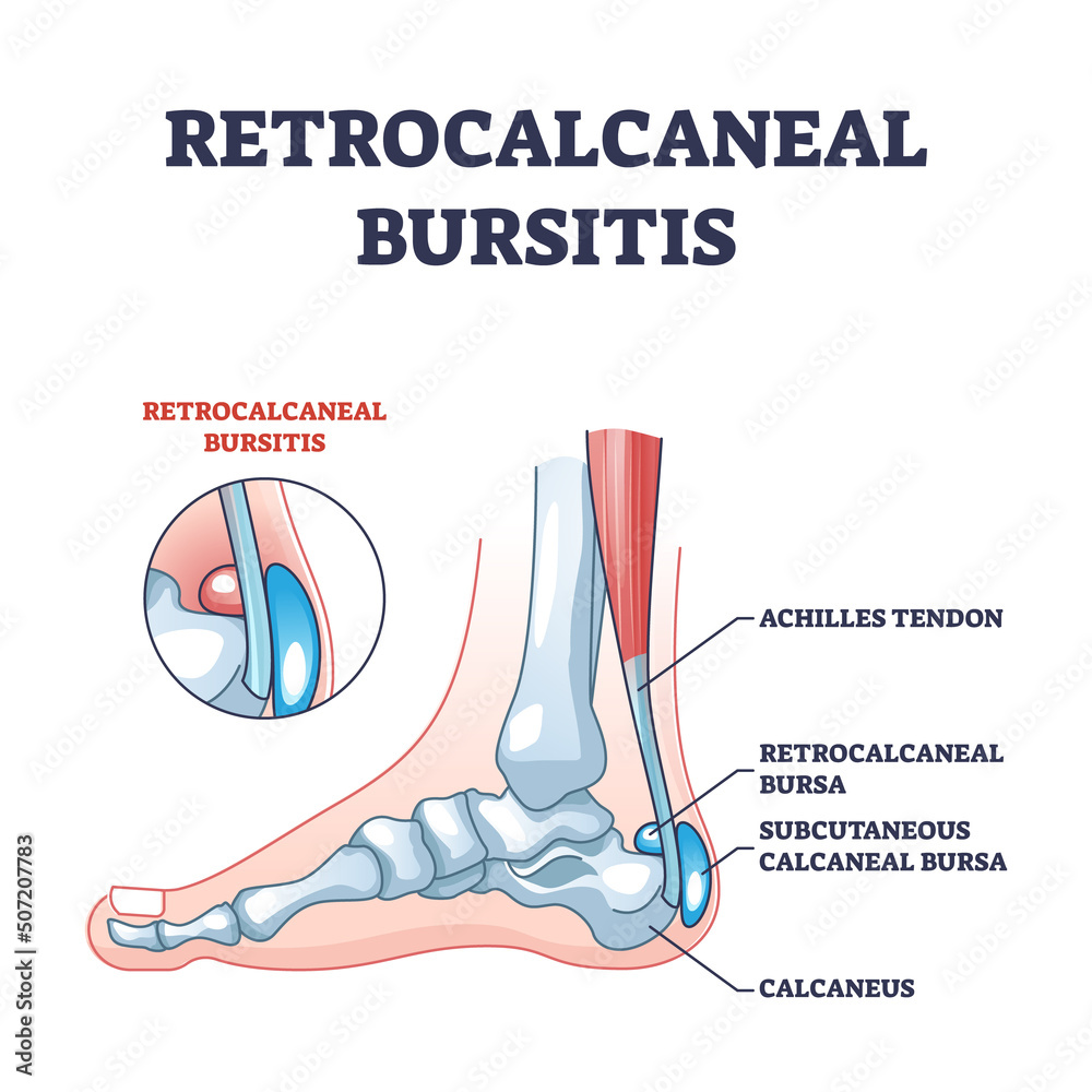 Poster Retrocalcaneal bursitis as ankle achilles tendon bursa outline diagram. Labeled educational medical condition with ligament or achilles tendon retrocalcaneal or subcutaneous pain vector illustration.