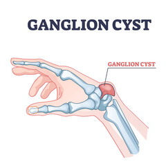 Ganglion cyst as tendon fluid filled swelling near arm joint outline diagram. Labeled educational scheme with anatomical hand bump xray explanation vector illustration. Painful wrist pathology growth. - obrazy, fototapety, plakaty