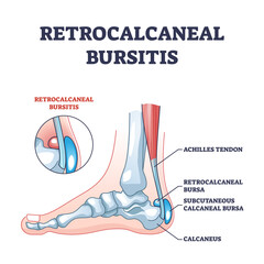 Retrocalcaneal bursitis as ankle achilles tendon bursa outline diagram. Labeled educational medical condition with ligament or achilles tendon retrocalcaneal or subcutaneous pain vector illustration. - obrazy, fototapety, plakaty