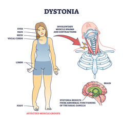 Fototapeta premium Dystonia disorder as abnormal muscle spasms and contractions outline diagram. Labeled educational scheme with affected body areas and symptoms vector illustration. Result of basal ganglia dysfunction.