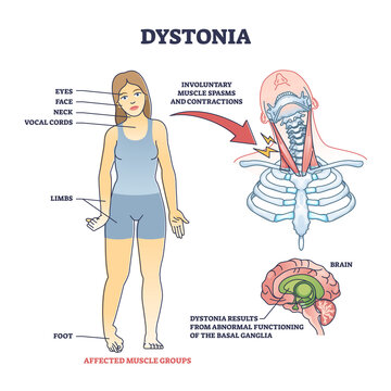 Dystonia disorder as abnormal muscle spasms and contractions outline diagram. Labeled educational scheme with affected body areas and symptoms vector illustration. Result of basal ganglia dysfunction.
