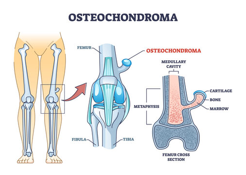 Osteochondroma knee problem as medical bone tumor overgrowth outline diagram. Labeled educational scheme with leg pathology explanation vector illustration. Femur cross section anatomical structure.
