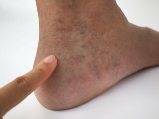 Naklejka premium Varicose veins on a leg and foot. closeup photo, blurred.