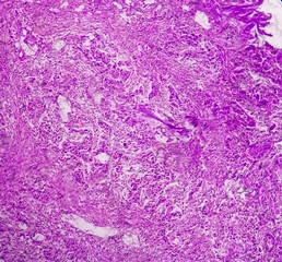 Bladder Cancer: High grade transitional cell carcinoma (TCC), Urothelial carcinoma