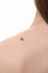 large nevus wart on young female shoulder, woman visiting doctor dermatologist, concept of benign neoplasms on human skin, regular examination and treatment.
