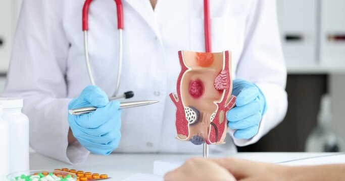 Anatomy of anus and intestines. Treatment of diseases of rectum hemorrhoids