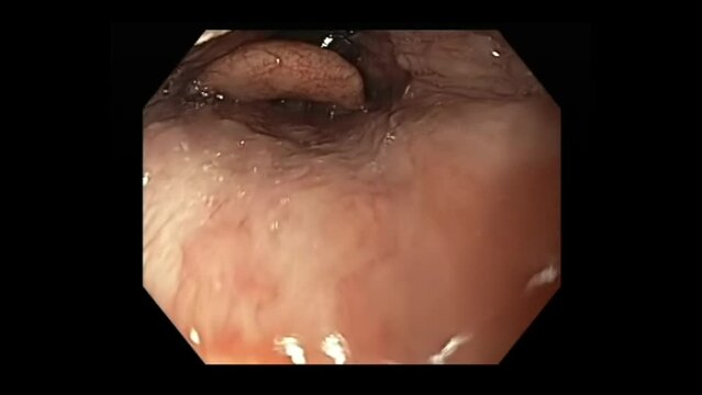 Endoscope Going Through The Throat During Esophagogastroduodenoscopy (EGD) Procedure. macro