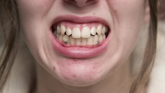 The concept of dental care and dentistry. Close-up of a happy unrecognizable caucasian woman smiling at camera, Elasticated braces set for teeth alignment and bite.