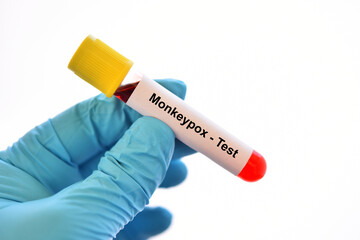 Obraz premium Blood sample tube for Monkeypox virus test, new epidemic disease in 2022