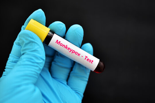 Blood sample tube for Monkeypox virus test, new epidemic disease in 2022