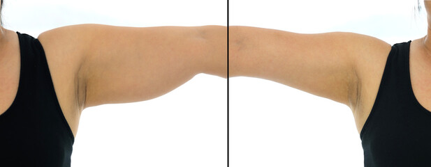 Comparison before and after Obesity Cellulite And Fat Removal liposuction Surgery on upper arm to...