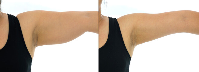 Comparison before and after Obesity Cellulite And Fat Removal liposuction Surgery on upper arm to get rid of sagging fat arm skin. Brachioplasty or Upper-Arm Lift plastic surgery in Asian woman.  - obrazy, fototapety, plakaty