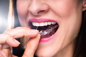 Woman Adjusting Transparent Aligners In Her Teeth