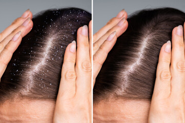Difference Of Hair With Dandruff - obrazy, fototapety, plakaty