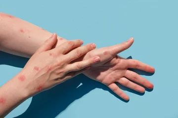 Foto op Aluminium Monkeypox new disease dangerous over the world. Patient with Monkey Pox. Painful rash, red spots blisters on the hand. Close up rash, human hands with Health problem. Banner, copy space © Marina Demidiuk