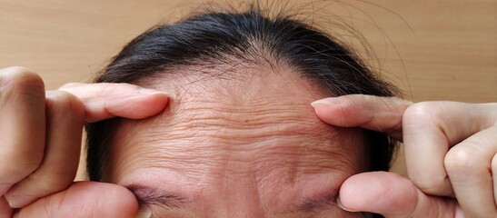Fototapeta premium Close up portrait showing the fingers touching the forehead lines of the woman, concept health care.