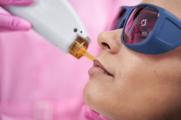 Professional laser hair removal procedure on a young female face