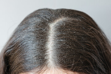 Close-up of the parting of brunette hair on the head covered with dandruff. The concept of...
