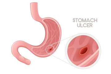 Human Stomach ulcer cartoon design human anatomy organ vector illustration on white background - obrazy, fototapety, plakaty