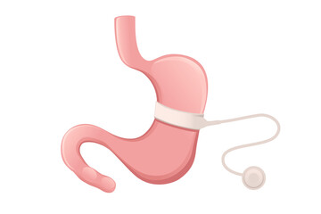 Human Stomach treatment gastric band concept cartoon design human anatomy organ vector illustration on white background