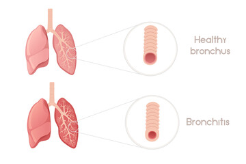 Human bronchi with bronchitis cartoon design human anatomy organ vector illustration on white background